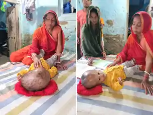  18 महीने का मासूम, डॉक्टर को भी नहीं पता बीमारी, सिर का वजन हुआ 10 किलो, इलाज के लिए मदद की गुहार